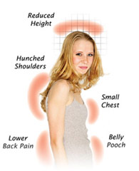 Bad postured girl with hunched shoulders, small chest, belly pooch and lower back pain